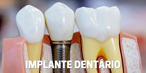 Implante Dentário - Dentista Itapevi/SP - Centro