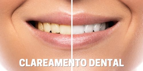 Clareamento Dental - Dentista Itapevi/SP - Centro