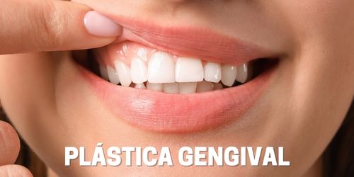 Plástica Gengival - Dentista Itapevi/SP - Centro