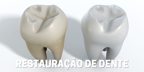 Restauração de Dente - Dentista Itapevi/SP - Centro